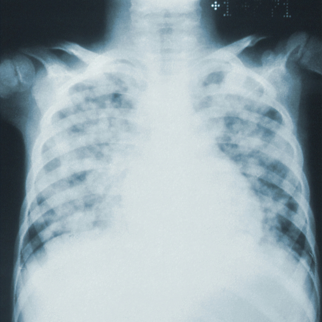 Pediatric Care 4 Cystic Fibrosis xray